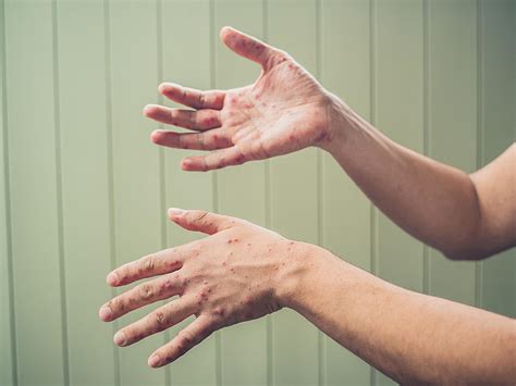 Highly Contagious Disease Spreads Into Another Hudson Valley Area