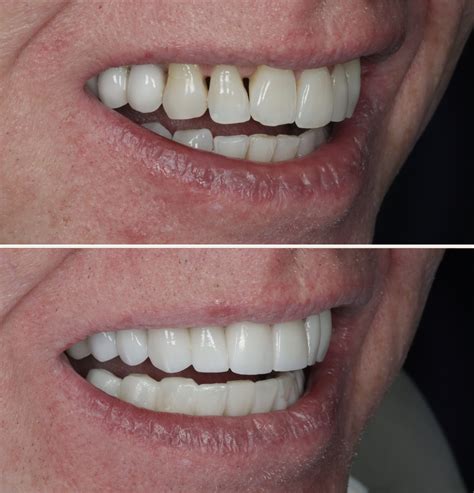 composite bonding   dental