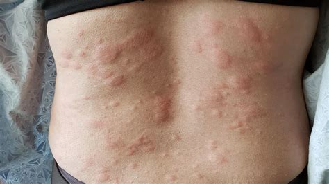 Hives vs rash pictures differences and symptoms – Artofit