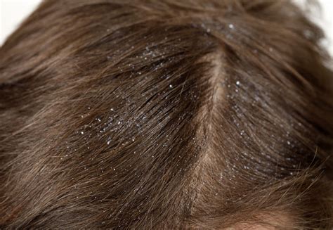 Scalp Psoriasis vs. Dandruff: Comparison and Treatment