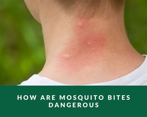 Mosquito Bite Allergy