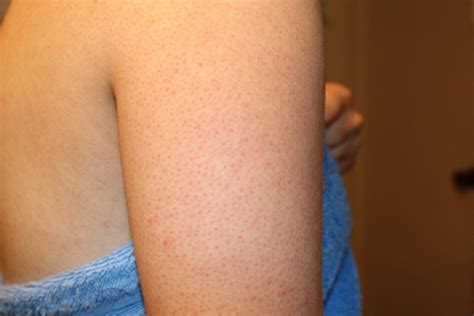 What is Chicken Skin - Keratosis Pilaris (KP) & Natural Treatments