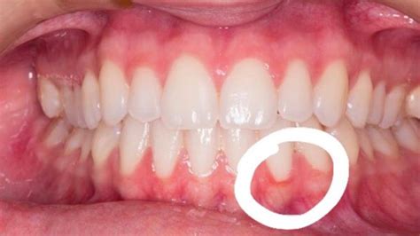 Gengiva Solta Do Dente
