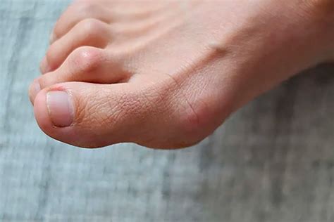 effective callus removal safe podiatric interventions
