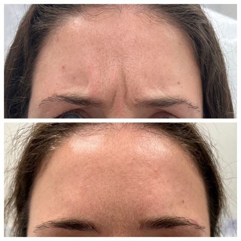 Botox 2 - Dream Spa Medical