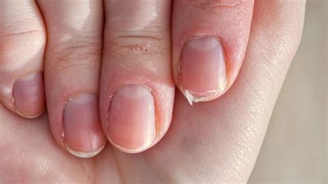 Unhas Quebradiças O Que Fazer - As unhas estão quebradiças? Saiba o que fazer!