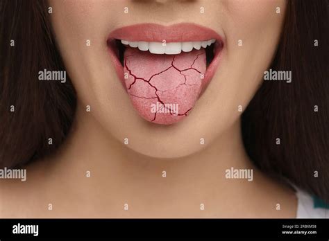 dry mouth symptom woman showing dehydrated tongue closeup stock photo