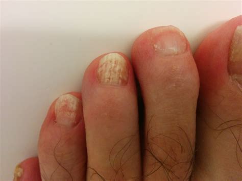 Fungus on both feet, left and right – Toenail Fungus