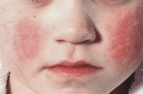 Scarlatina - vaccineaza.md