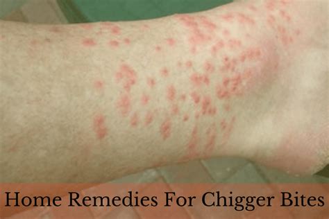 23 Home Remedies To Get Rid Of Chigger Bites At Home