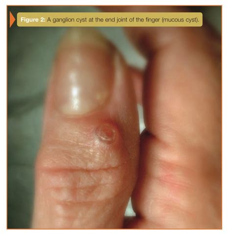 ganglion cyst excision jonathan twu md
