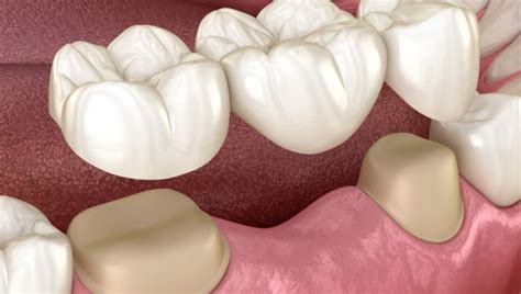 Prótesis fija | Tipos y Materiales - Clínica Dental Tacna