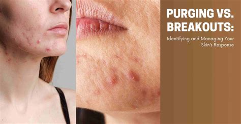 purging  breakouts identifying  managing skins response