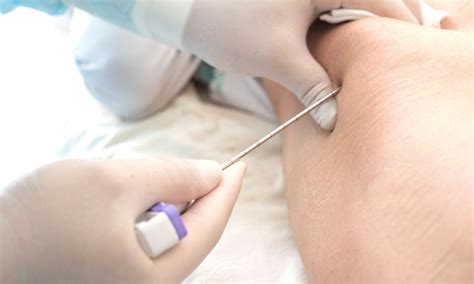 Para Que Serve A Biopsia - Biópsia de medula óssea: para que serve e como é feita - Revista Online ...