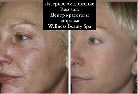 Лазерное омоложение RecoSMA