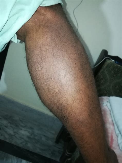 Ask a Dermatologist Online for Severe Itching On Legs