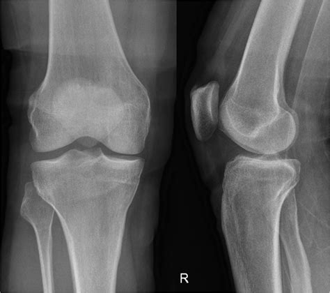 Dislocation of the proximal tibiofibular joint, do not miss it | BMJ Case Reports