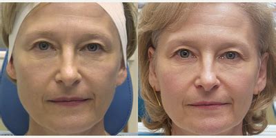 Sculptra Before & After Pictures - RealSelf
