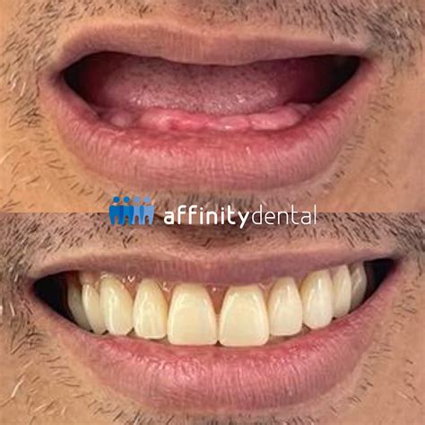Complete Dentures – Affinity Dental Clinics BGC High Street - Affinity