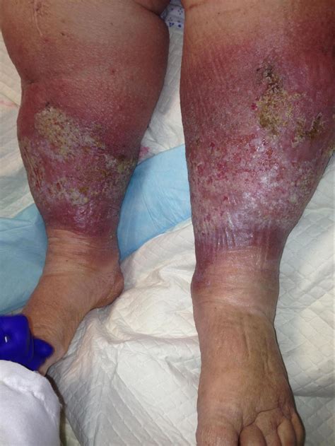 Cellulitis Infection