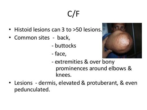 Histoid leprosy