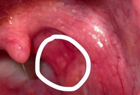 Ulcer On Tonsil