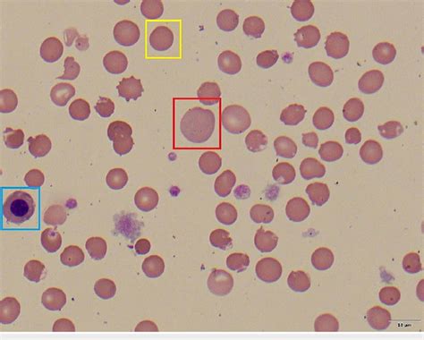 Peripheral blood smear (100x) -image 1 Peripheral blood smear showing a ...