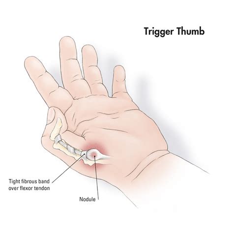 Carpal Tunnel Syndrome - Computer Related Health Issues