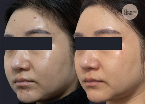 skin lightening clinic  sydney  melasma clinic