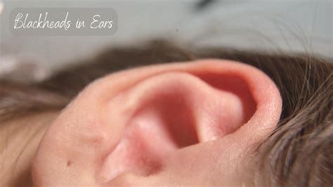how to get rid of blackheads in ears overnight