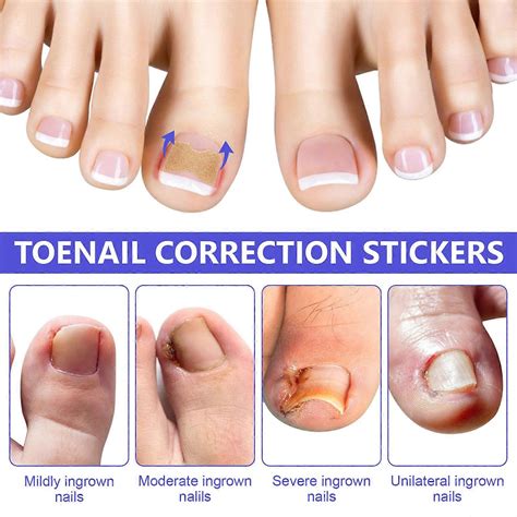100 Pcs Ingrown Toenail Sticker Elastic Foot Nail Care Pedicure Tool