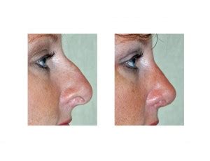 case study rhinoplasty correction   hooked nose explore plastic