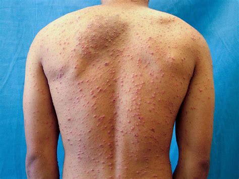 14 Causes of a Pimple-Like Rash