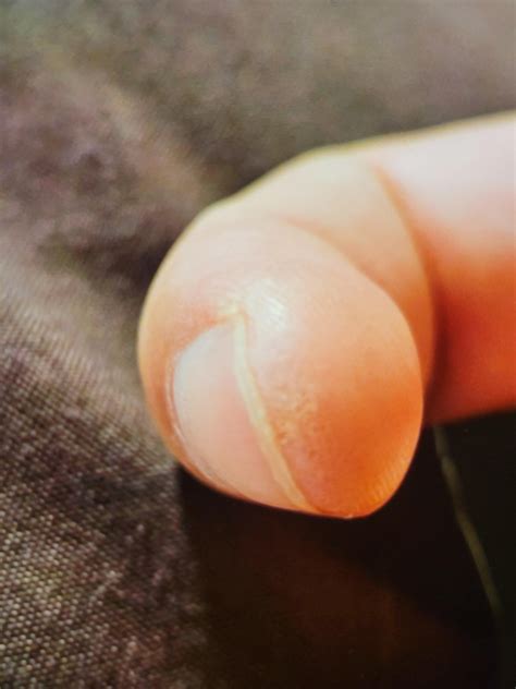 10 year old warts finally going away with Zinc. : r/Warts