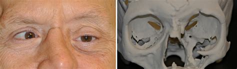 Plastic Surgery Case Study - Custom Orbital Floor Implant for ...