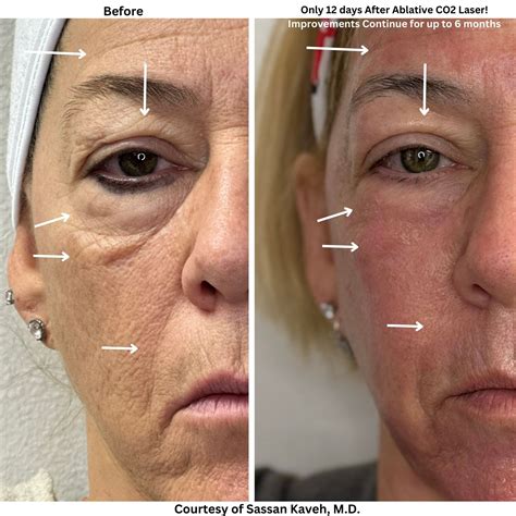 laser treatment face cost 5
