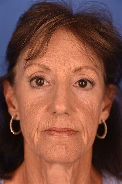 Brow Lift Results in Boca Raton, FL | Dr. Gregory Albert