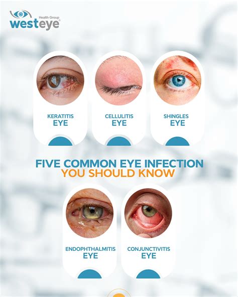Westeye - Our eyes speak louder than words… unless they’re infected