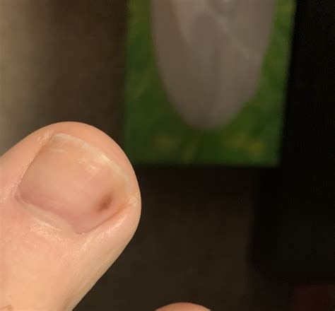 Bruise under nail? | Mumsnet