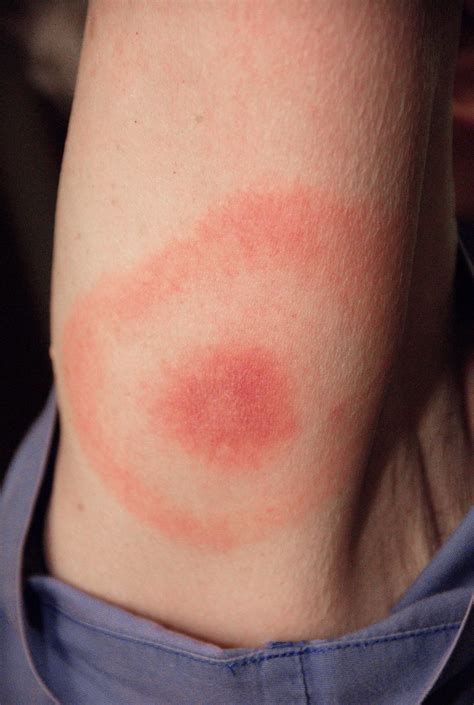 As Lyme Disease Cases Rise, Tips for Protecting Against Tick Bites ...