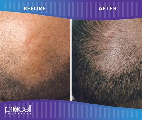 Procell Microchanneling Before And After| Seattle Aesthetics