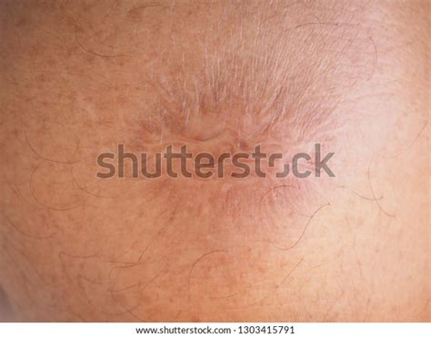 115 Contracture Scar Images, Stock Photos & Vectors | Shutterstock