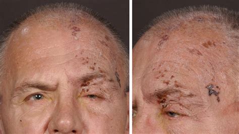 herpes zoster  herpes simplex vrogueco