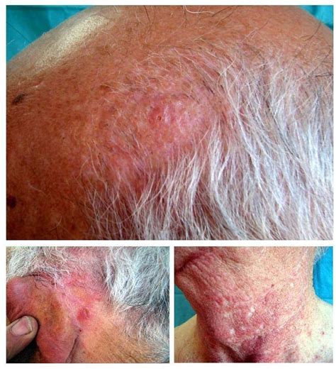 Figure 1 from Scalp folliculitis with Demodex: innocent observer or ...