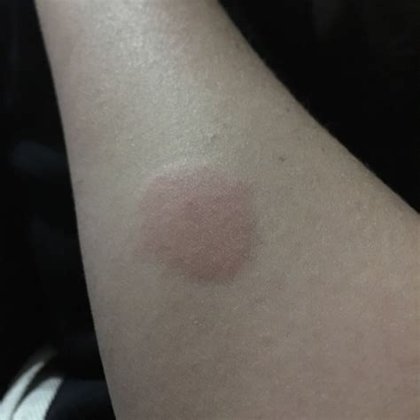 Is this positive? (TB skin test) - Glow Community