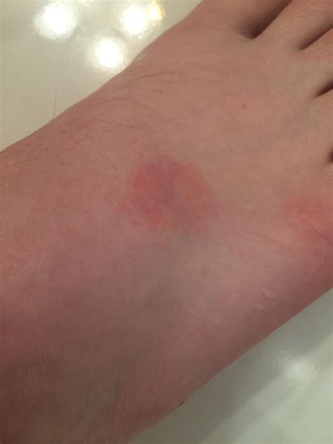 Spiritual Meaning Of Itchy Feet - Piwik Thecable