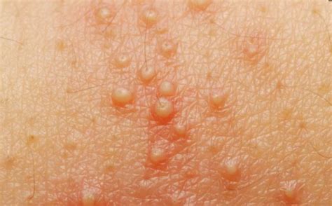 Postule Acne Causes And Treatment Options