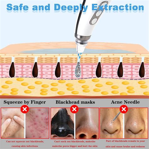 Why The Newest Blackhead Removal Videos 2023 Are Viral Trends For Skincare Enthusiasts Seeking Professional Extraction Tips 7