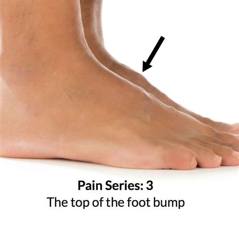 severe pain top  foot common   treatment  top