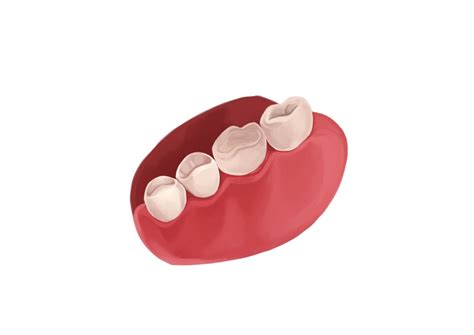 What types of fillings are available for cavities? | Authority Dental